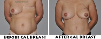 stemcell-breast-reconstruction-thailand