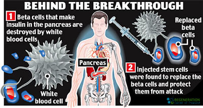 treat-diabetic-neuropathy-stem-cells