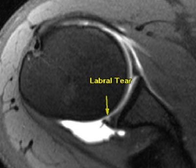 Shoulder-labral-tear-before-stemcell-therapy