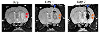 before-after-stemcells-stroke-brain