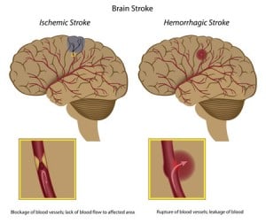 Neurogenic Stem Cell Treatment For Stroke Recovery