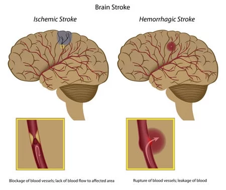 ischemic stroke vs hemorrhagic stroke