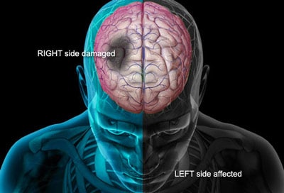 right-left-side-after-stroke