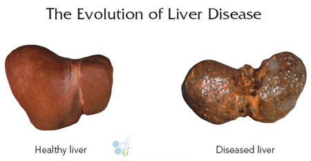 Compare-End-Stage-Liver-Disease-Cure-Treatment