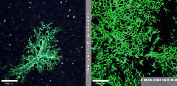 after-lung-stem-cell-treatment-copd-thailand