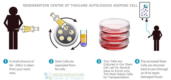 Adipose Tissue Derived Stem Cells ASC Therapy