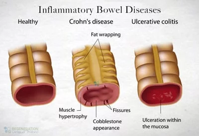 Inflammatory-bowel-disease-cure-stem-cells