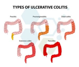 Ulcerative-Colitis-treatment-stem-cells