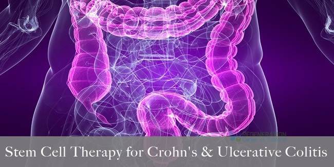 Treatment For Crohns Disease Ulcerative Colitis Ibd Autoimmune 4933