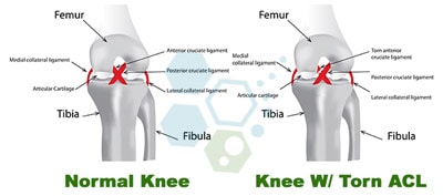 https://stemcellthailand.org/wp-content/uploads/2016/01/repair-torn-ACL-stemcells.jpg