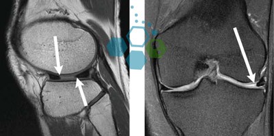 stem-cell-injection-knee