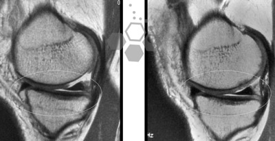 stem-cell-injections-for-knee-arthritis