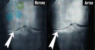 stem-cell-knee-arthritis-treatments