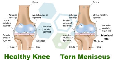 torn-Meniscus-stemcells