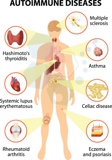 Chemotherapy for lupus: How it works, types, and side effects