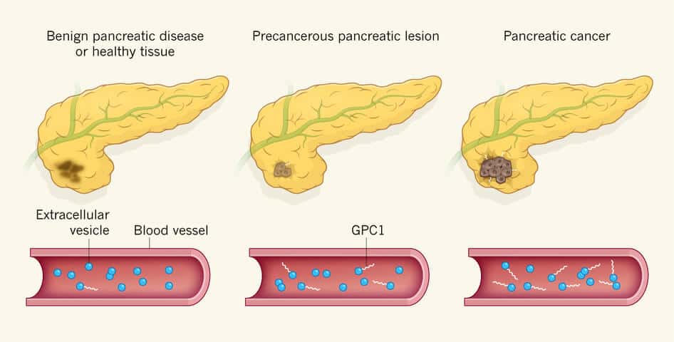 Stem Cells For Pancreas Cancer Adenocarcinoma Immunotherapy