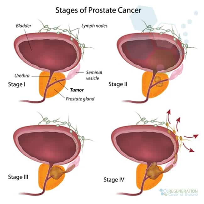 Immunotherapy Stem Cells For Treating Prostate Cancer