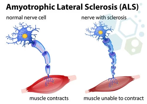 Stem Cell treatment for ALS Lou Gehrig's disease