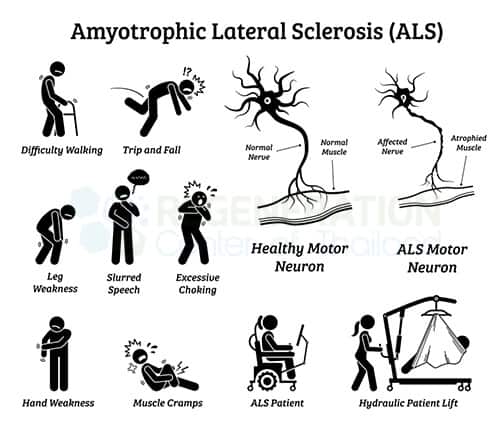 How is ALS Diagnosed and Treated?