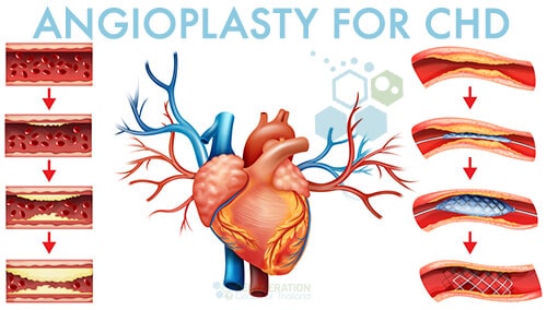 coronary artery disease treatment