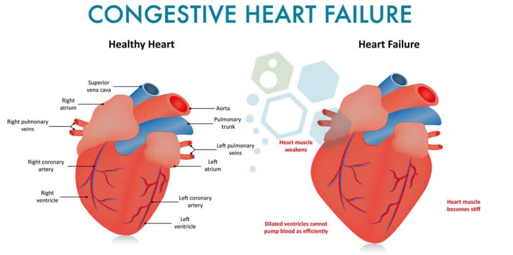 Congestive-heart-failure