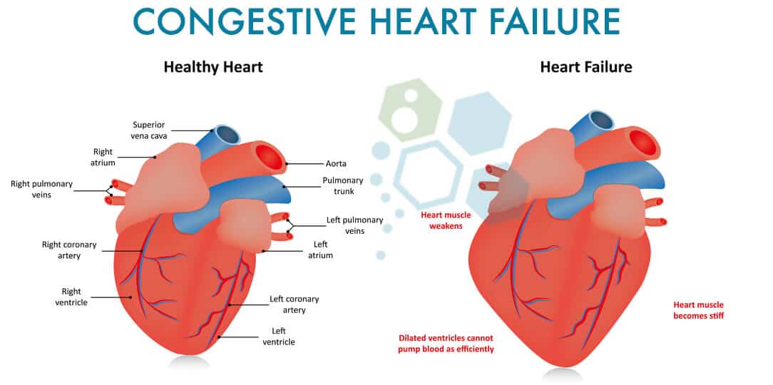 Cardiopoietic Stem Cell Therapy Congestive Heart Failure [CHF]