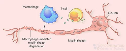 Amyotrophic lateral sclerosis (ALS), motor neurone disease (MND)