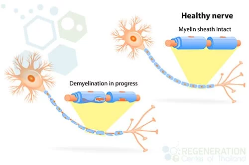 What are the stages of ALS?