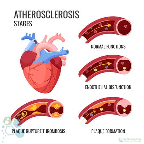 Arterial Plaque: How Heart Plaques Affect Cardiovascular Health