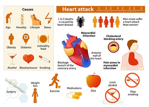 Msc Cardiopoietic Stem Cell Therapy After Heart Attacks Mi