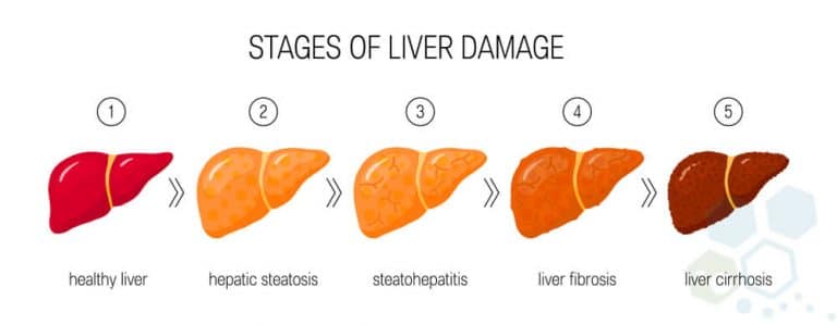 Stem Cell Therapy for Liver Disease & Cirrhosis of The Liver