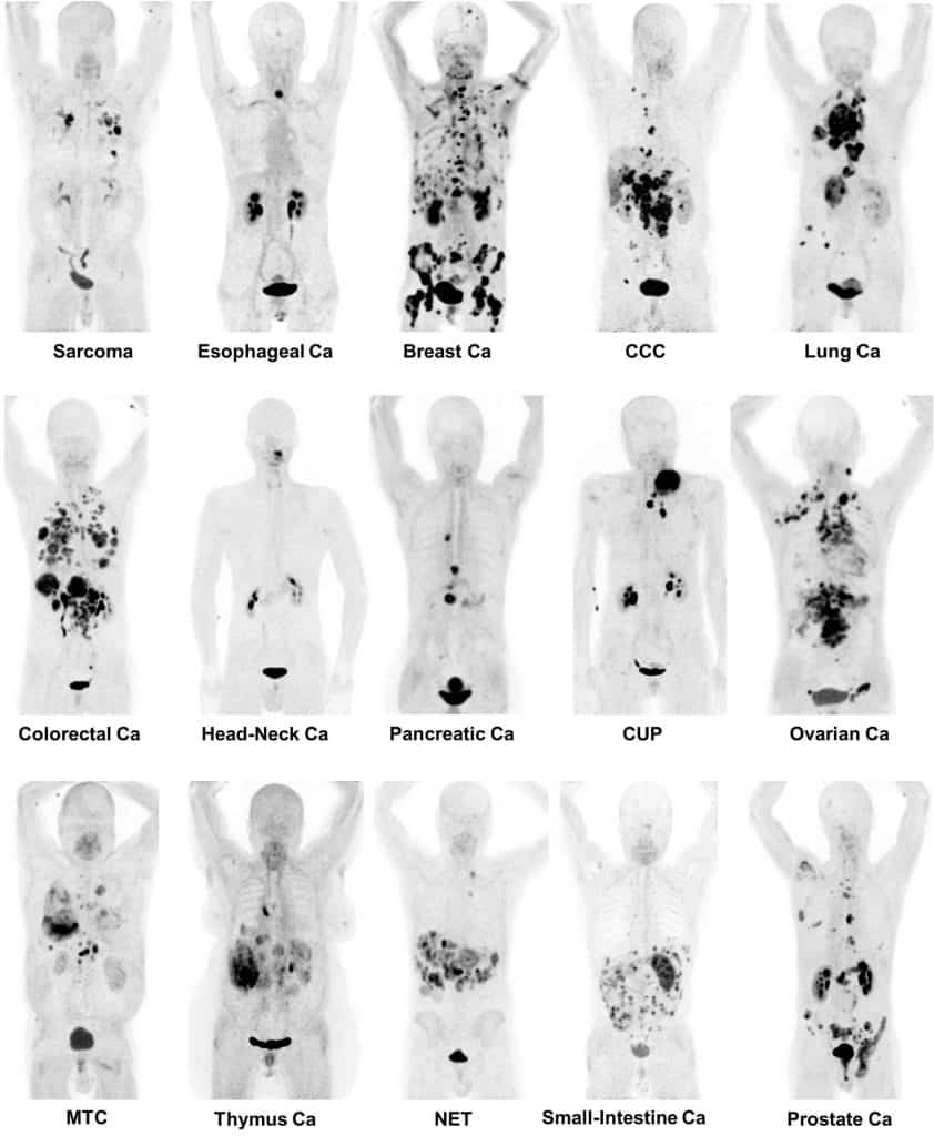 ct scan for types of cancers
