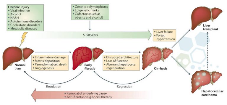 Stem Cell Therapy for Liver Disease & Cirrhosis of The Liver