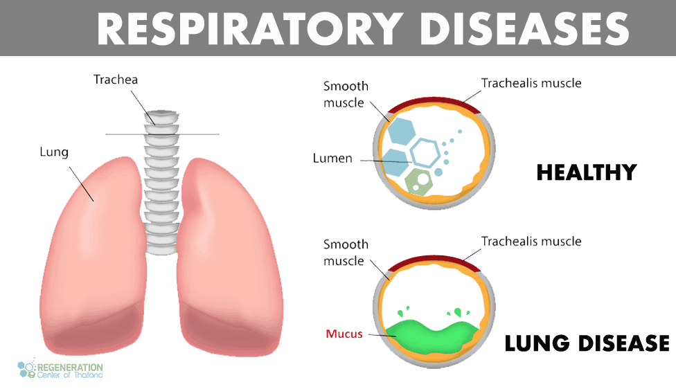 Pulmonary Stem Cells For Ipf Lung Fibrosis Ild Scarring