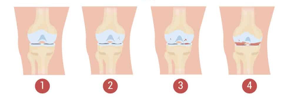 stages-knee-osteoarthritis-stemcells