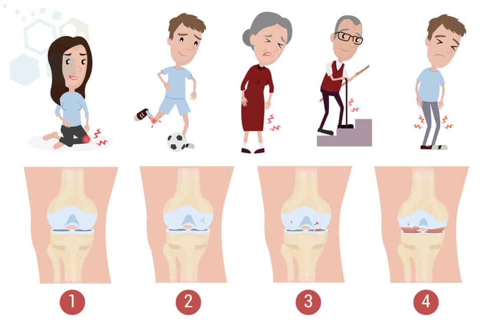 osteoarthritis knee swelling