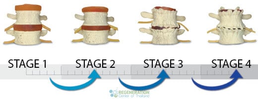 stages-of-ddd-stemcells