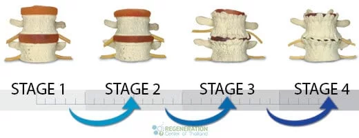 Stages Of Degenerative Disc Disease Neck