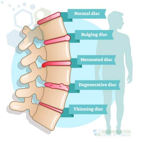 https://stemcellthailand.org/wp-content/uploads/2019/07/stem-cells-spinal-stenosis-e1561995504994.jpg