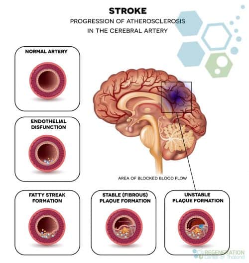 stroke-treament-tissue-plasminogen-activator