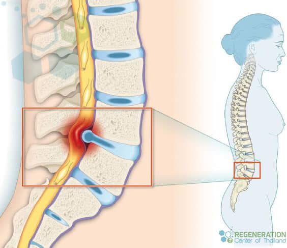 stem cell treatment for lower back pain alternative to surgery-for-ddd