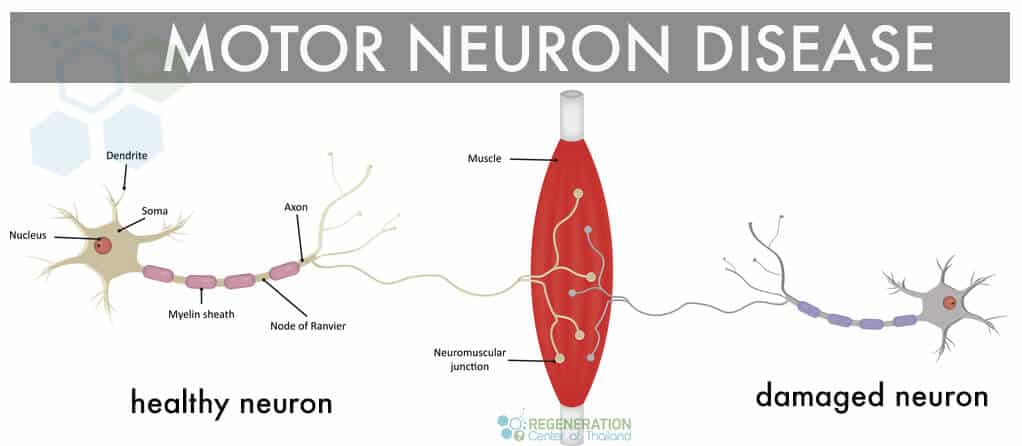 types-neurons-bulbar-mnd-als