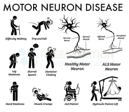 Stem Cell Treatment For Motor Neuron Disease Mnd