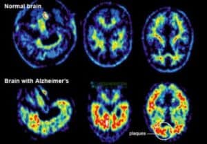 Alzheimers-dementia-comparison-normal-brain-stemcells