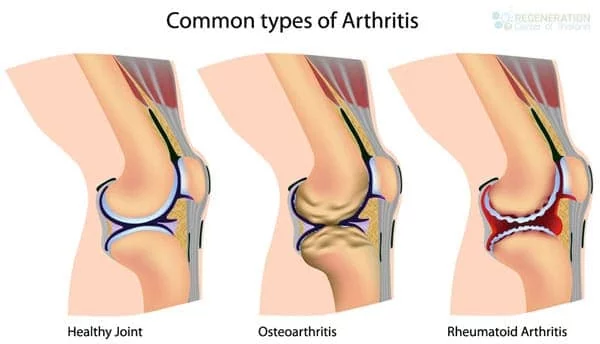 types-of-Arthritis-treated-stem-cells