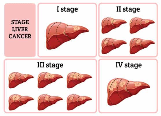 4-stages-liver-cancer