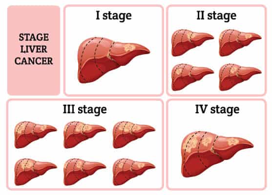 CAR T Therapy Stem Cells For Liver Cancer