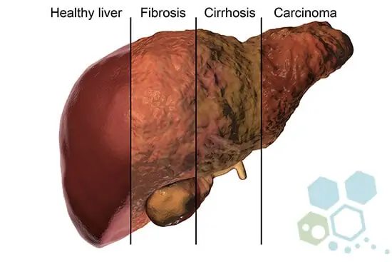 liver-cancer-progression-stages