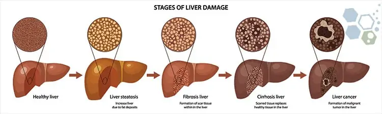 stages-liver-damage-after-cancer