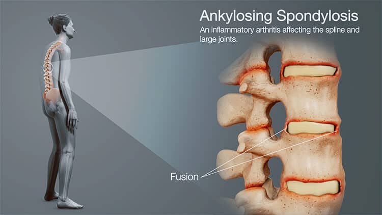 spondyloarthritis ankylosing spondylitis 